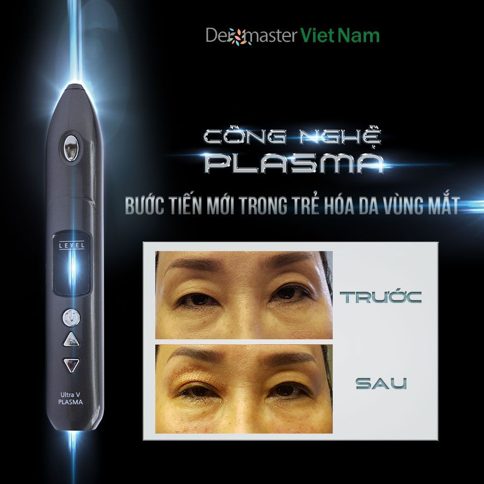 Giá nhấn mí mắt bao nhiêu tiền – bảng giá nhấn mí Plasma tại Dermaster VietNam