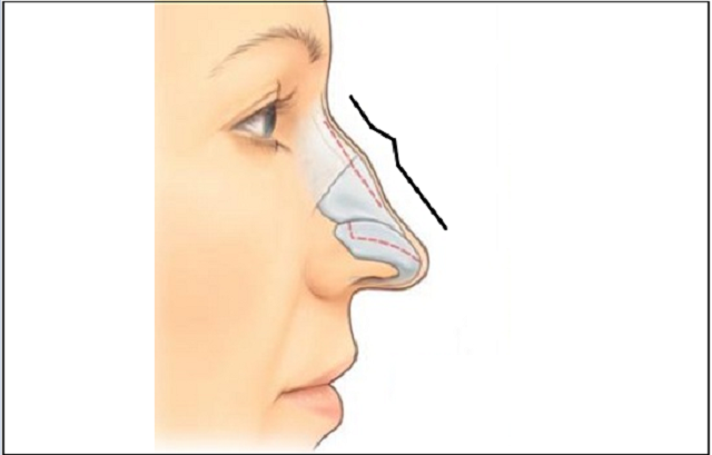 #Mũi gồ là gì - Phương pháp chỉnh sửa mũi gồ hiệu quả 3