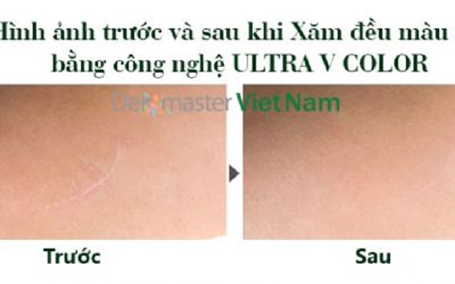 Phun xăm che sẹo hiệu quả tại Dermaster Việt Nam 3
