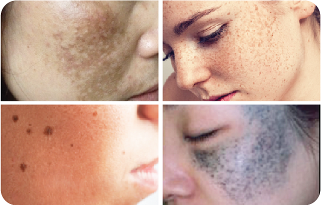 Tăng sắc tố da là gì và cách khắc phục tăng sắc tố 1
