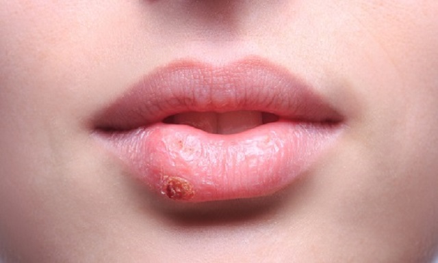 Xăm môi bị hỏng thì nên làm gì để khắc phục nhanh nhất?