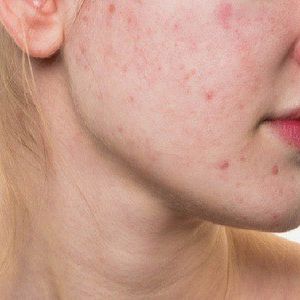 acne-stay-away-tri-mun-viem-cung-bioflash-care-trong-7-ngay