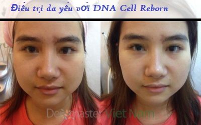 Restruture And Recharge Skin DNA Damages - Sửa chữa và Nuôi dưỡng da tổn thương với DNA tinh khiết
