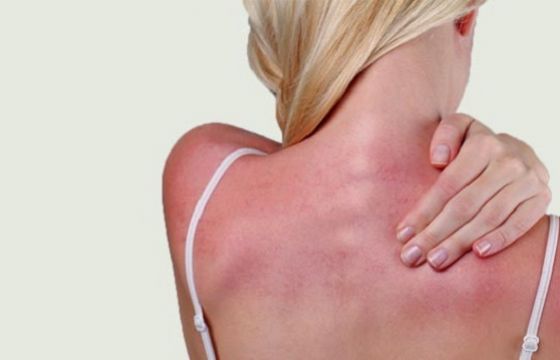 Sun poisoning là gì? ảnh hưởng của Sun poisoning đến da