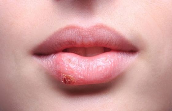 Xăm môi bị hỏng làm gì để khắc phục nhanh nhất?