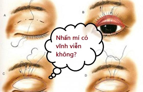 nhan-mi-mat-co-vinh-vien-khong